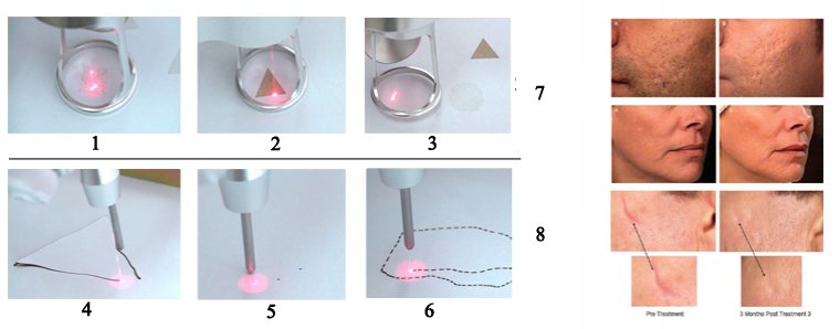 Kosmetikgerät, Fraktionierte CO2-Laserbehandlung / Fraktionierte CO2-Lasertherapie