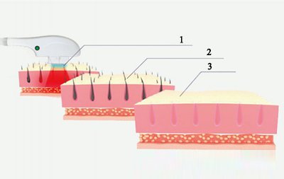 IPL SHR Gerät, E-light IPL RF SHR Dauerhafte Haarentfernung