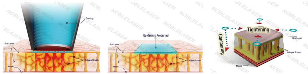 Kosmetikgerät, Hautstraffung mit Thermage, Thermage-Behandlung