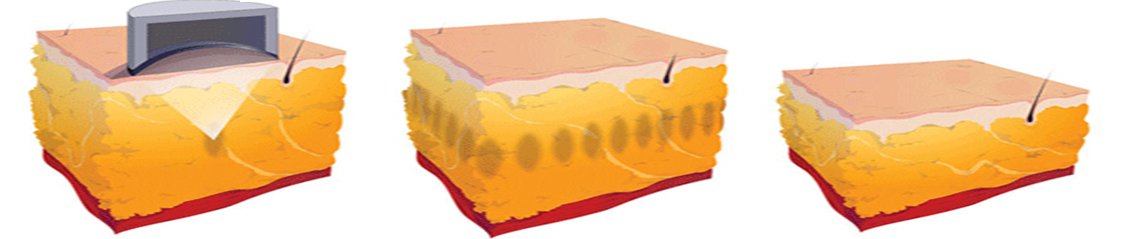 Liposonix Behandlung, Körperformung mit Liposonix